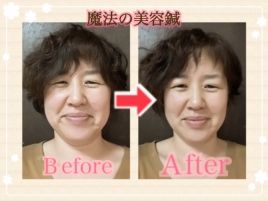 整体・美容鍼灸サロンonon(オンオン） 魔法の美容鍼９回コースのメニュー画像
