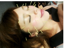 芦屋 楓鍼灸院  電気を流さない美容鍼のメニュー画像