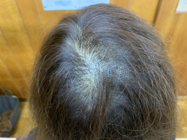 平井鍼灸療院　平井薬局 女性の薄毛抜け毛漢方鍼灸治療のメニュー画像