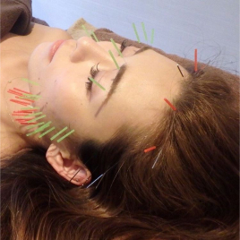 美容鍼　ledia(ルディア) 堀江店 お顔と頭皮の美容鍼のメニュー画像