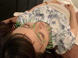 ジェイペック鍼灸整骨院 ジェイペック式美容鍼　スタンダードコースのメニュー画像