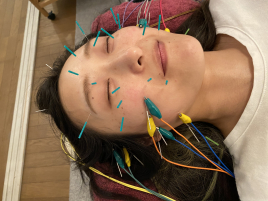 鍼灸接骨院Kira  美容鍼（電気を流す）のメニュー画像