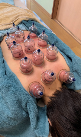 ユズリハ鍼灸治療院 吸い玉　カッピングのメニュー画像