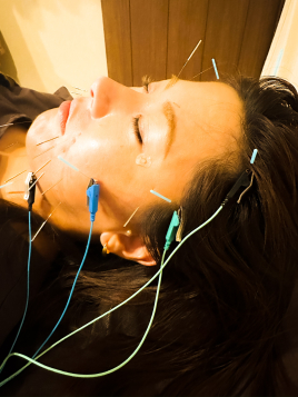 「おでかけ」のための鍼灸サロン　mata-tabi 電気を流す、攻めの美容鍼／初回のメニュー画像