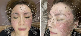 美容鍼専門　まちばり鍼灸院 ルート治療による鬼美容鍼のメニュー画像