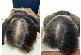 美容鍼専門　まちばり鍼灸院 ルート治療による薄毛治療のメニュー画像