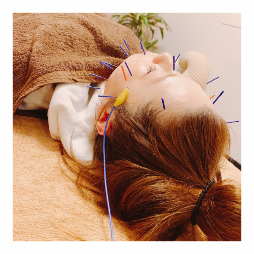 鍼灸サロンMAKOTO 美容鍼のメニュー画像