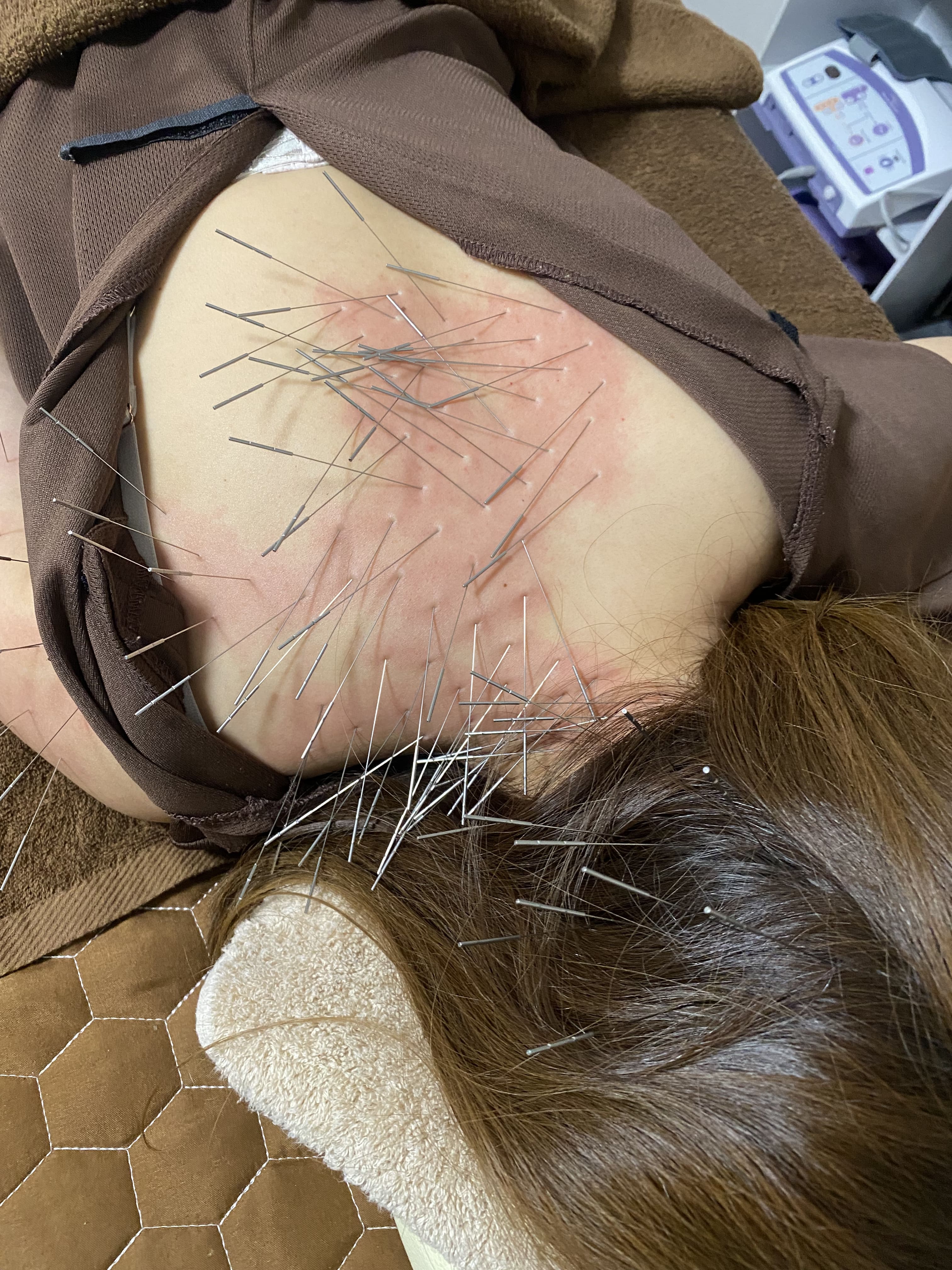 福岡八女ひめの鍼灸院 ルート鍼治療60分のメニュー画像