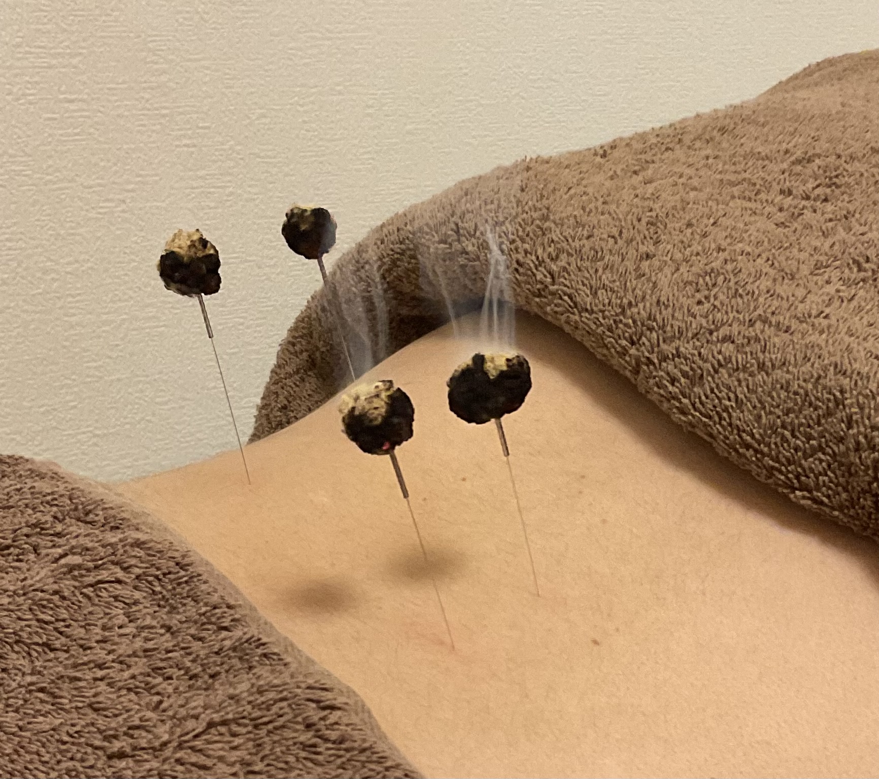 佐々木鍼灸院 基本鍼治療のメニュー画像