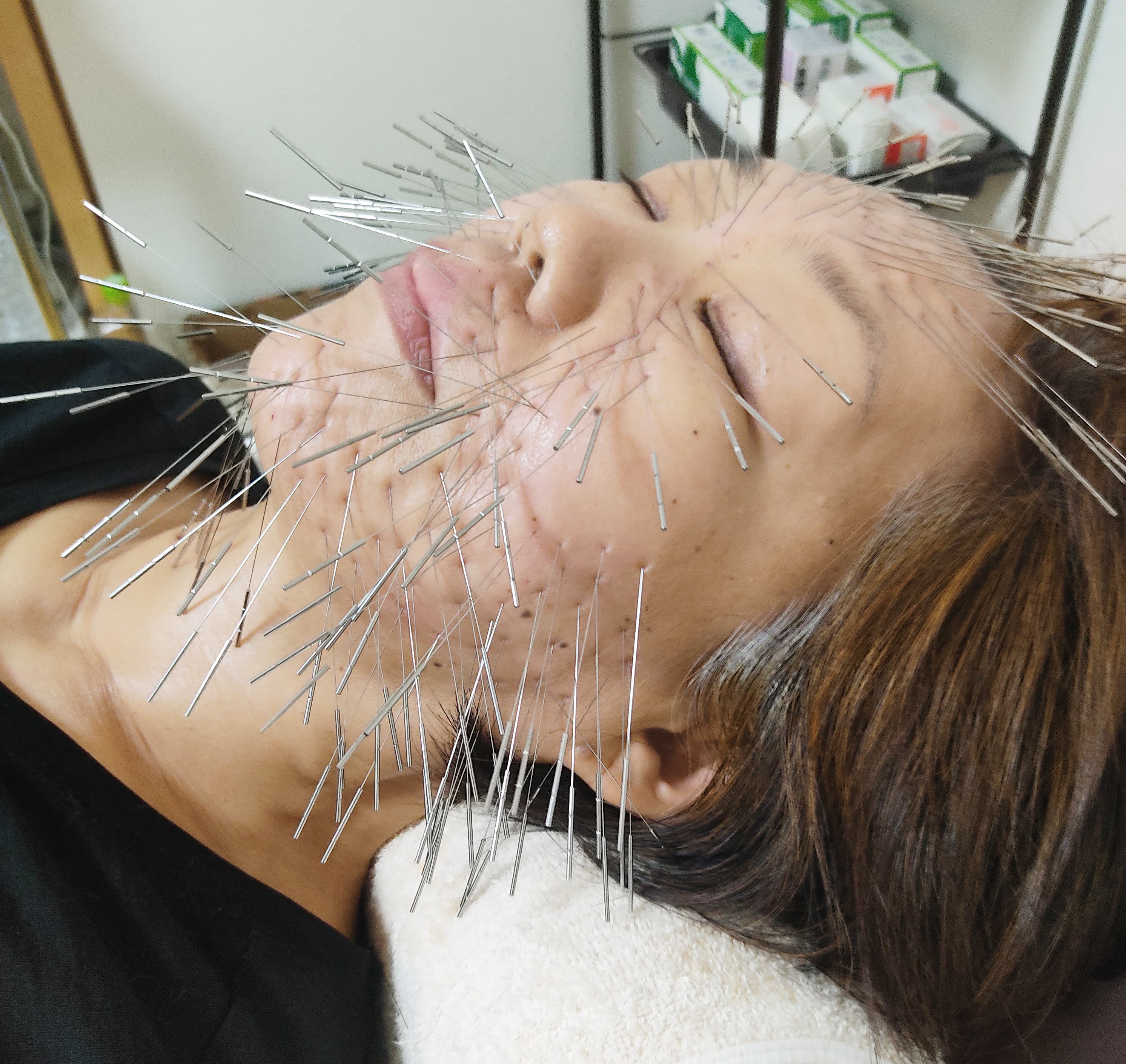 きやま鍼灸治療院  【ルート治療専門院】 ルート美容鍼のメニュー画像