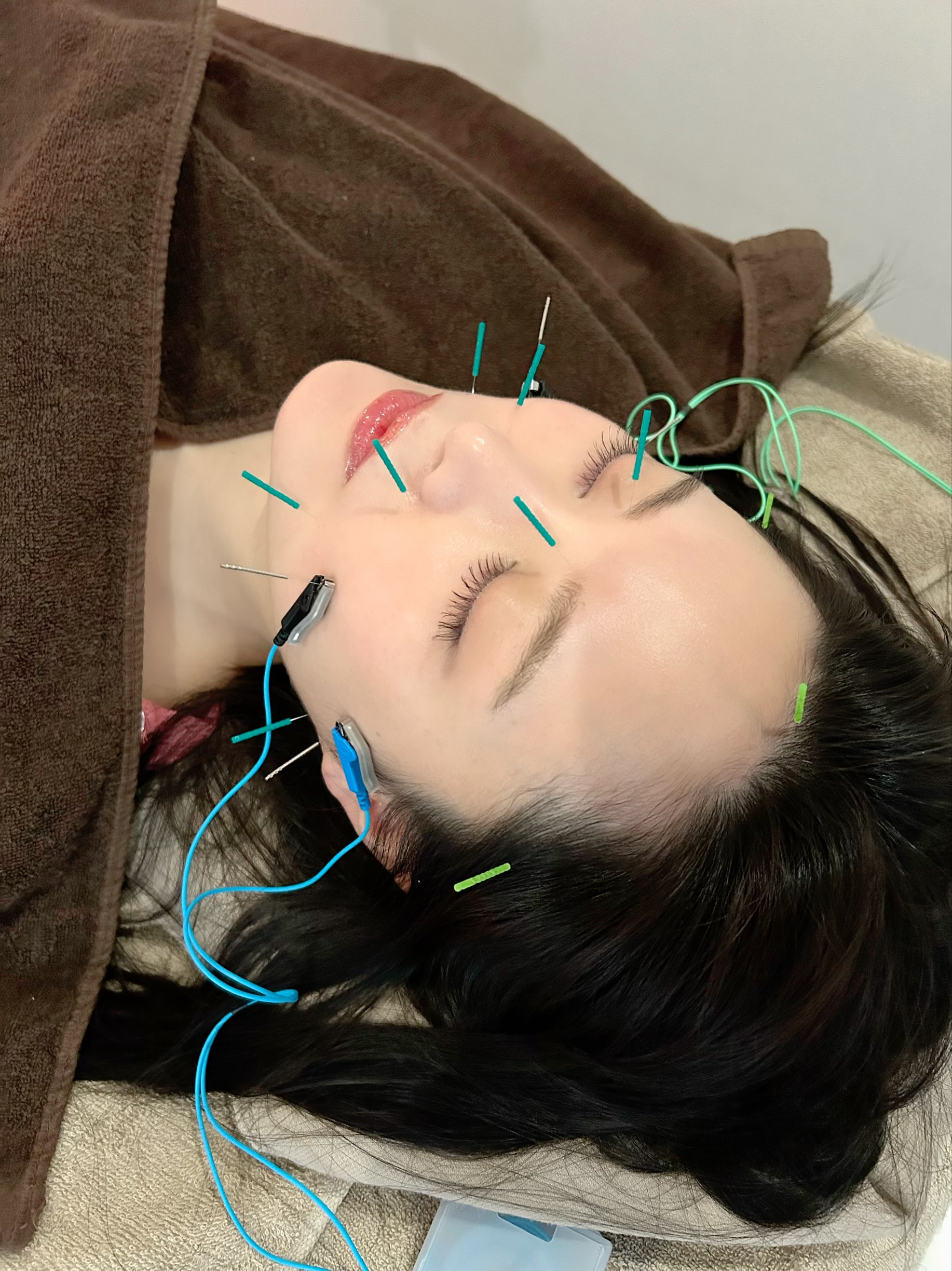 鍼灸サロン紅葉-MOMIJI- リフトアップ美容鍼のメニュー画像