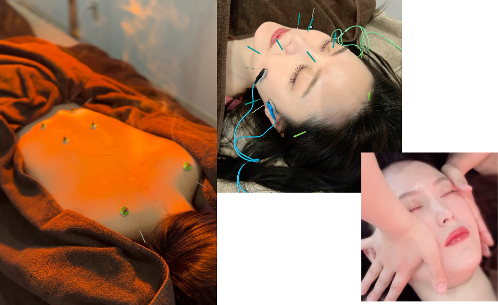 鍼灸サロン紅葉-MOMIJI- 小顔矯正美容鍼のメニュー画像