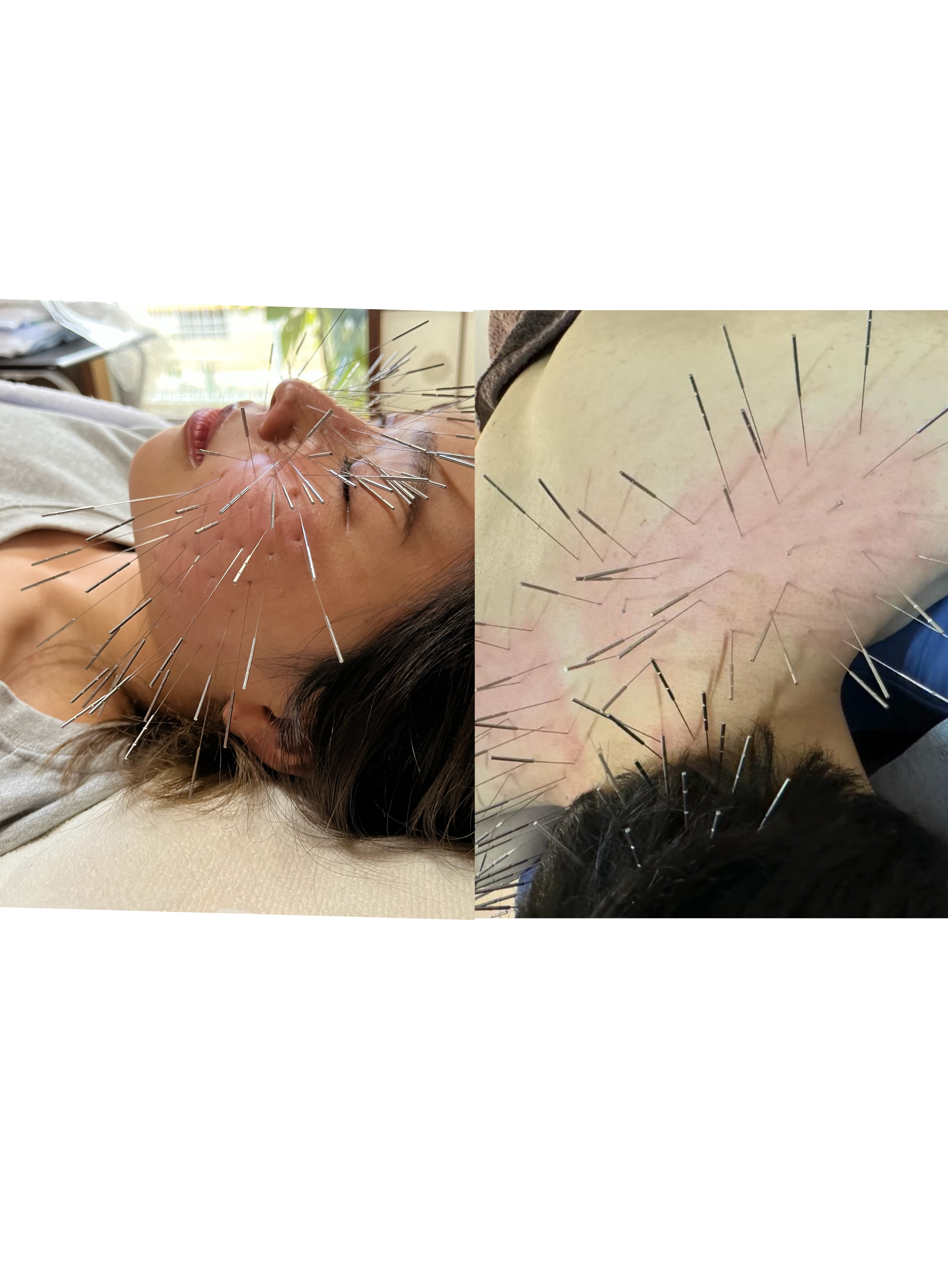 鍼処HIKARIE（旧光鍼灸院） 鬼美容針＋ルート治療【90分】のメニュー画像