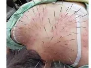 はり処もり (ルート鍼専門院)