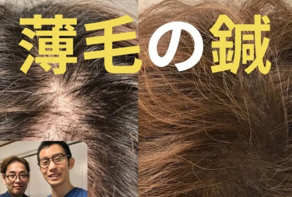 中野区野方鍼灸院のむち鍼