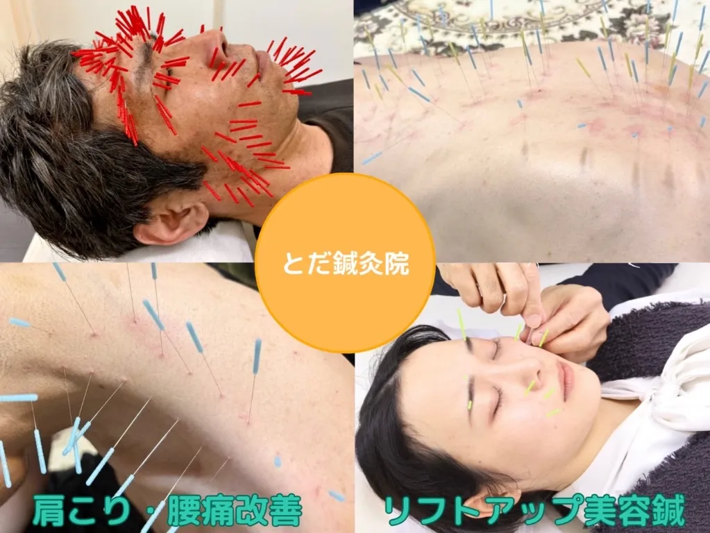 肩こり・腰痛・とだ鍼灸院(トリガーポイント鍼専門)