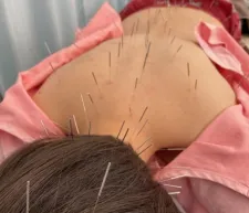 ルルド鍼灸