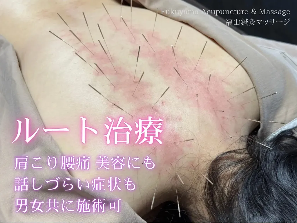 【ルート治療・鬼美容鍼】福山鍼灸マッサージ