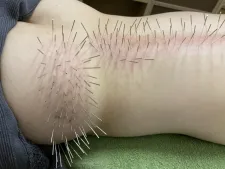 鍼灸サロンacus(アクス)ルート鍼治療専門