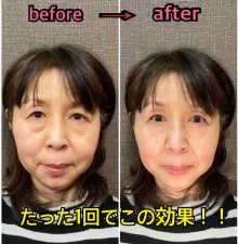 福山小顔美容鍼サロン