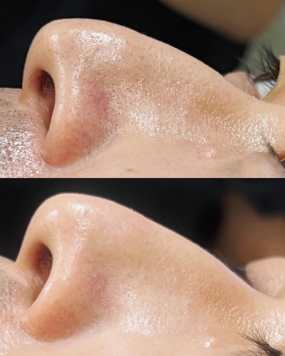 Relama美容鍼✕マッサージのこだわりポイント