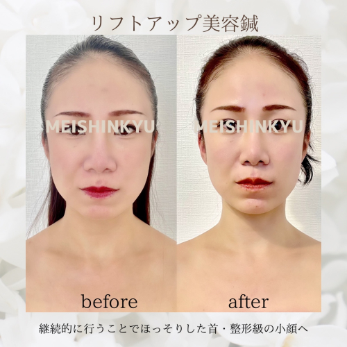 小顔・アンチエイジング鍼灸　　めい鍼灸院　-meishinkyu-のこだわりポイント