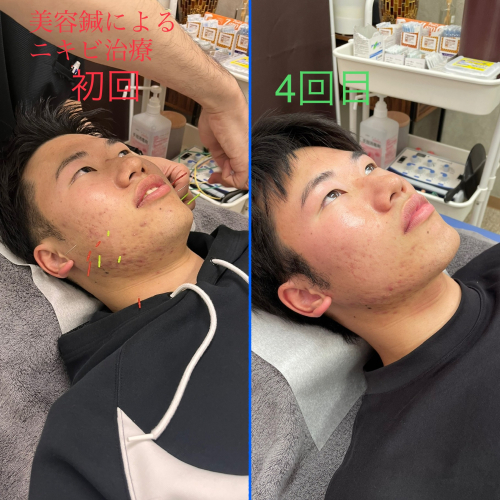 美容鍼サロン harry's Nのこだわりポイント