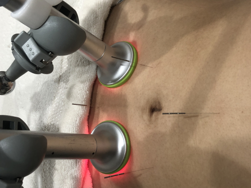 Ｓｙｕｏｎ朱音　鍼灸院のこだわりポイント