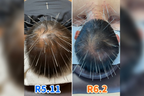 ルート鍼灸治療院ほむらのこだわりポイント