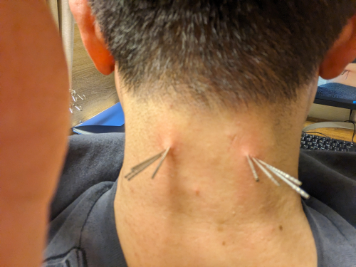 鍼灸屋　小久保拓郎のこだわりポイント