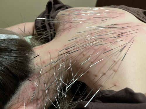 ORIENT THERAPY　ルート治療・鬼神美容鍼（ルート治療ベース）・電気美容鍼・刺さない極美鍼・難聴特化型鍼サロンのこだわりポイント