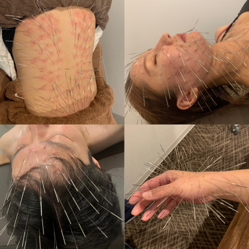 鍼灸整体Salon Acuwill【ルート治療✖️自己治癒整体】のこだわりポイント