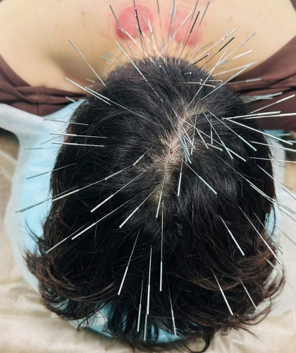 美身堂えいち鍼灸院 〜ルート治療・美容鍼〜のこだわりポイント