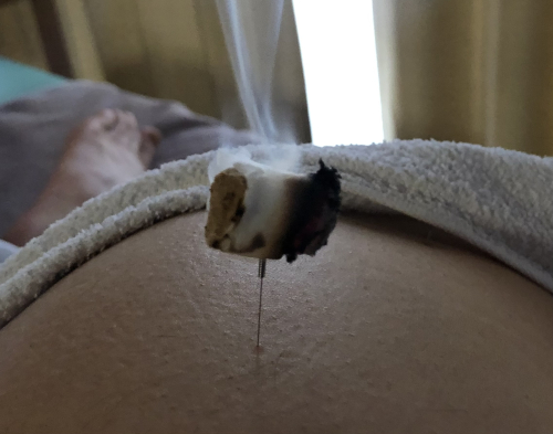 鍼灸彩彩　お灸とはりのさいさいのこだわりポイント