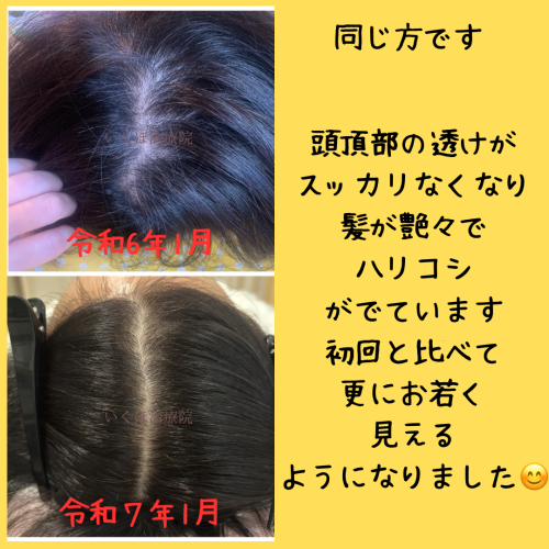 薄毛鍼 本気で向き合う いくほ治療院のこだわりポイント