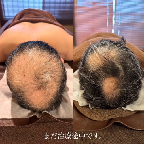 広島美容鍼【月陽堂鍼灸治療院】ルート治療のこだわりポイント