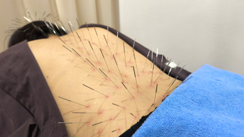 しおやき鍼灸整骨院【ルート治療認定院】のこだわりポイント