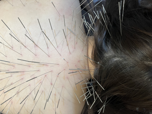 Runa(大阪梅田ルート治療と癒着はがし)のこだわりポイント