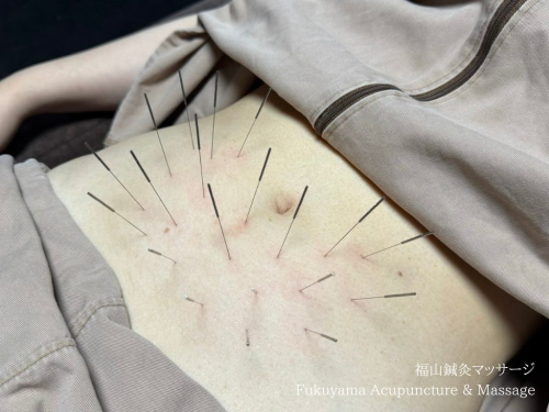 【ルート治療・鬼美容鍼】福山鍼灸マッサージのこだわりポイント