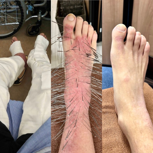 【ルート治療専門鍼灸院】鍼侍のこだわりポイント