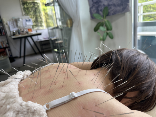 鍼灸院【 MEGURT 】広島ルート治療のこだわりポイント