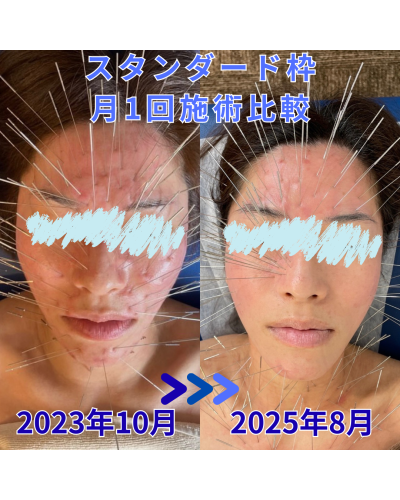 鍼処NAOTOのこだわりポイント