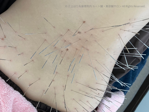 三上はり灸接骨院内 ルート鍼・美容鍼サロンのこだわりポイント