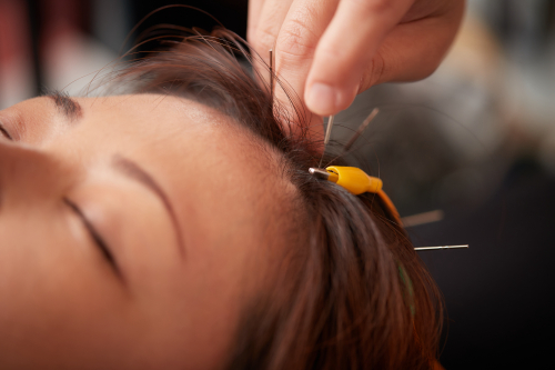 美楽鍼のこだわりポイント