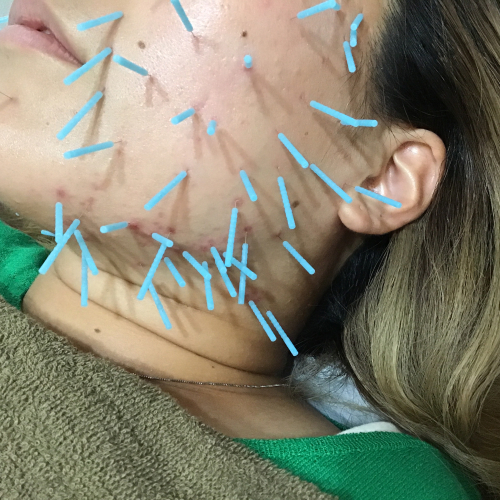 肌質改善専門 美容鍼デイジ―所沢店のこだわりポイント