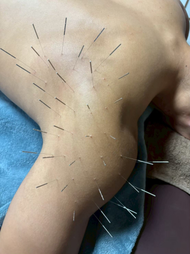 鍼打人　Aomori    ルート治療のこだわりポイント