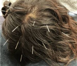 AGA・FAGA・薄毛育毛鍼　　頭皮髪再生治療専門　ハリのち晴れ 鍼灸治療院　浦和院のこだわりポイント