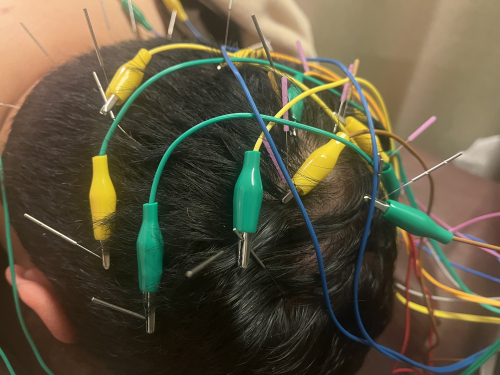 AGA・FAGA・薄毛育毛鍼　　頭皮髪再生治療専門　ハリのち晴れ 鍼灸治療院　浦和院のこだわりポイント