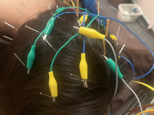 AGA・FAGA・薄毛育毛鍼　　頭皮髪再生治療専門　ハリのち晴れ 鍼灸治療院　浦和院のこだわりポイント