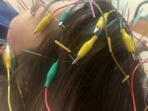 AGA・FAGA・薄毛育毛鍼　　頭皮髪再生治療専門　ハリのち晴れ 鍼灸治療院　浦和院のこだわりポイント